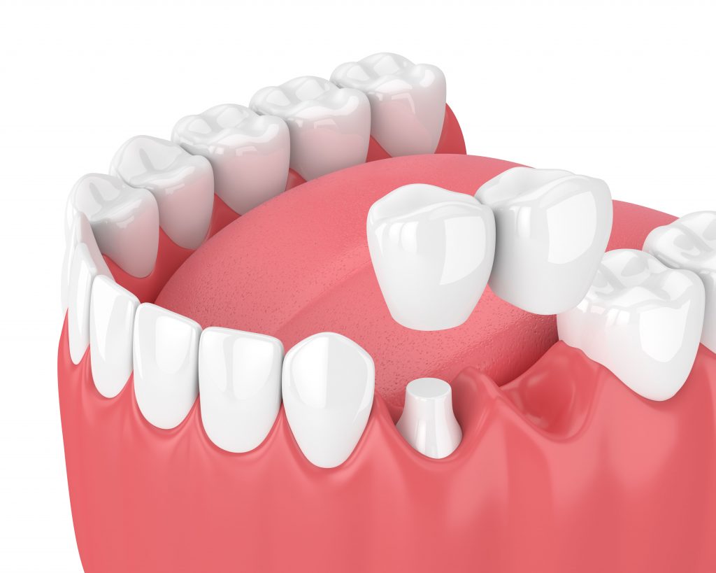 Cantilever dental bridges gold coast