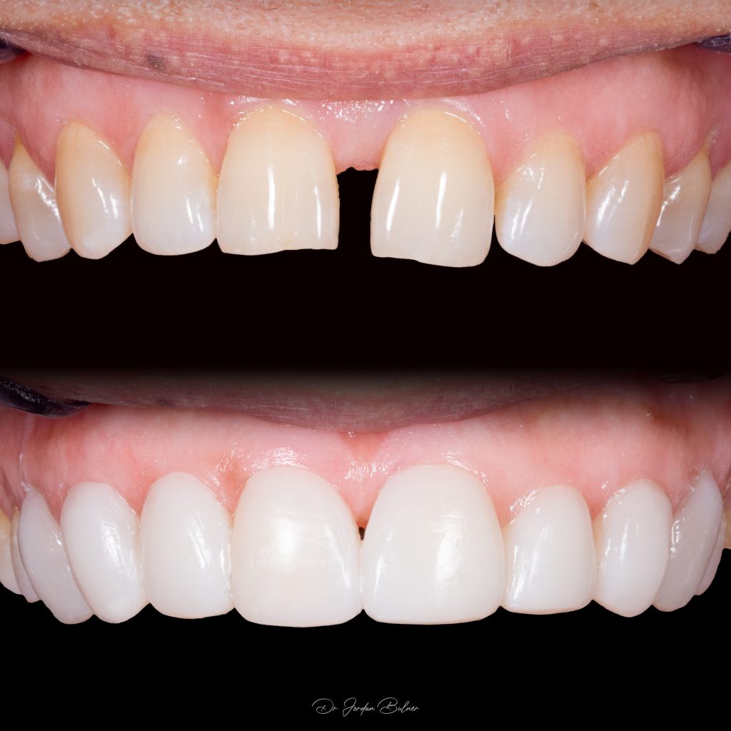dental veneers gold coast Dental Veneers Nerang, Gold Coast