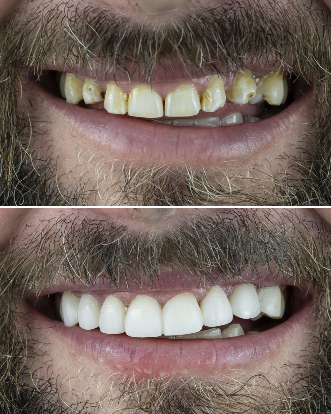 Veneers Gold Coast