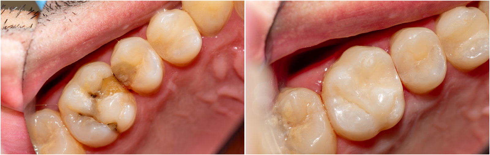 Dental Fillings, Inlays Onlays