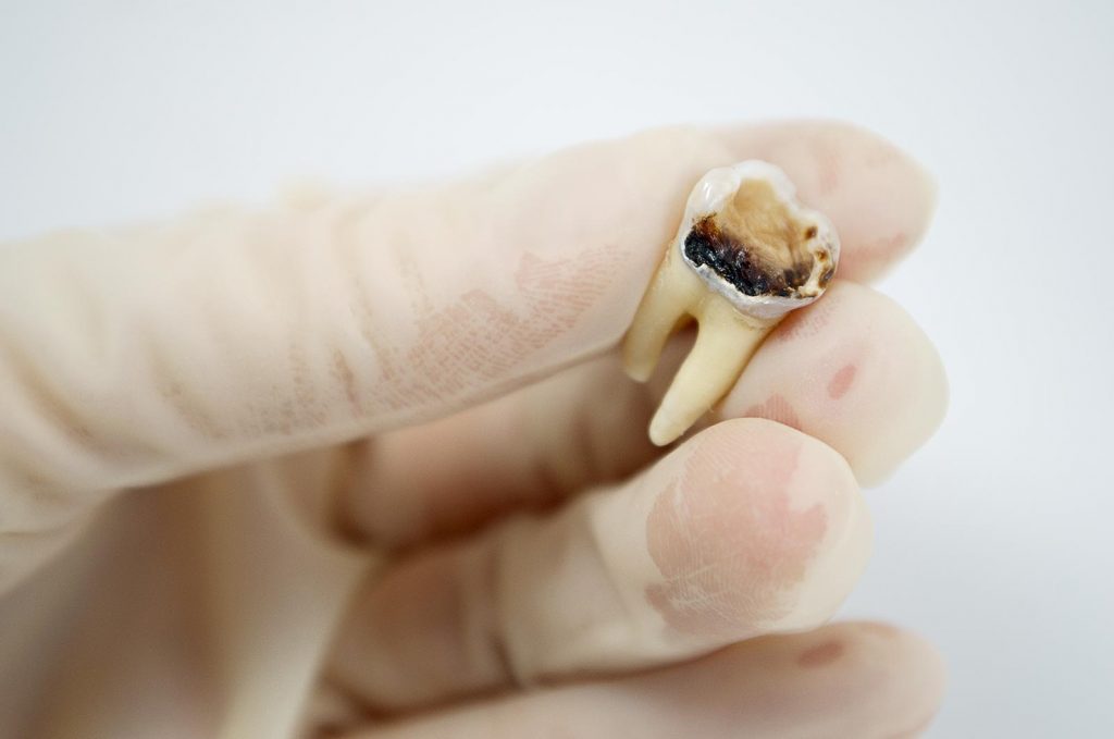 tooth extraction gold coast tooth extraction gold coast