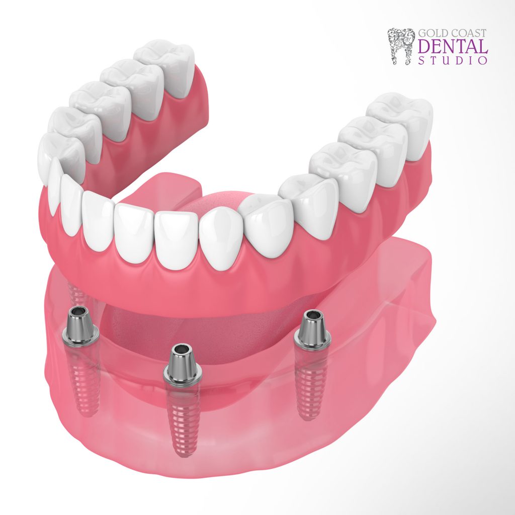 All on Four Dental Implants