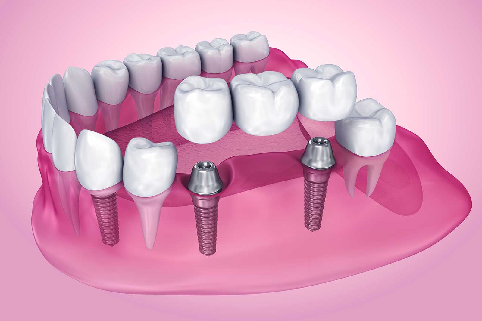 Dental Implants Gold Coast