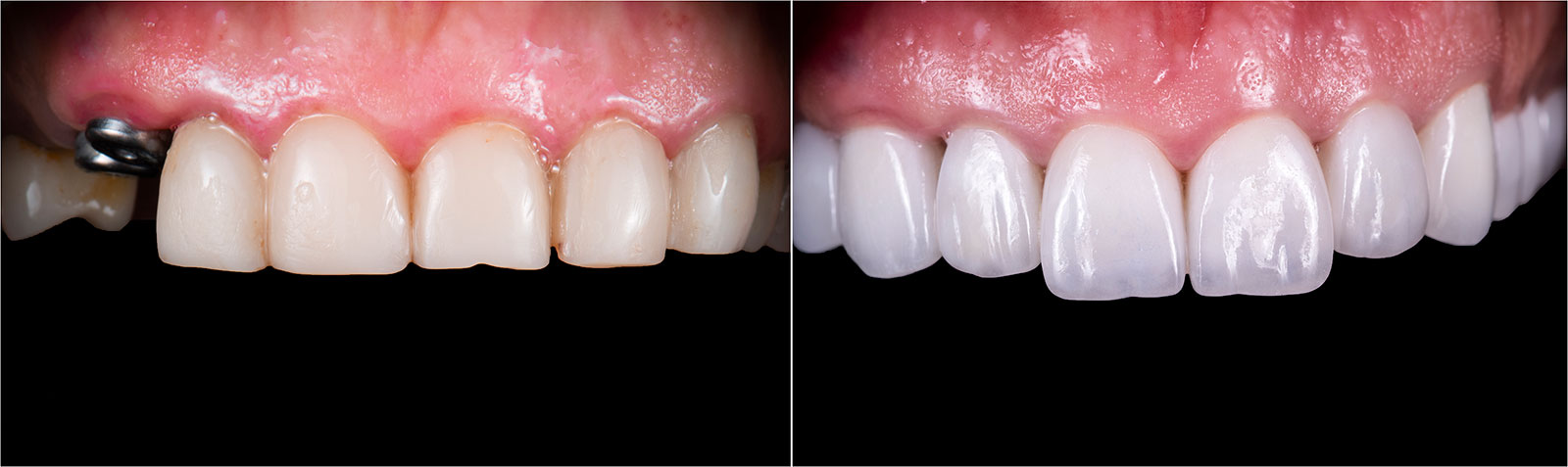 dental implants before and after