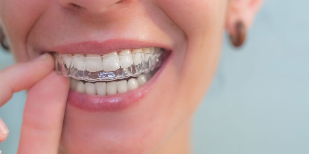 clear aligners gold coast