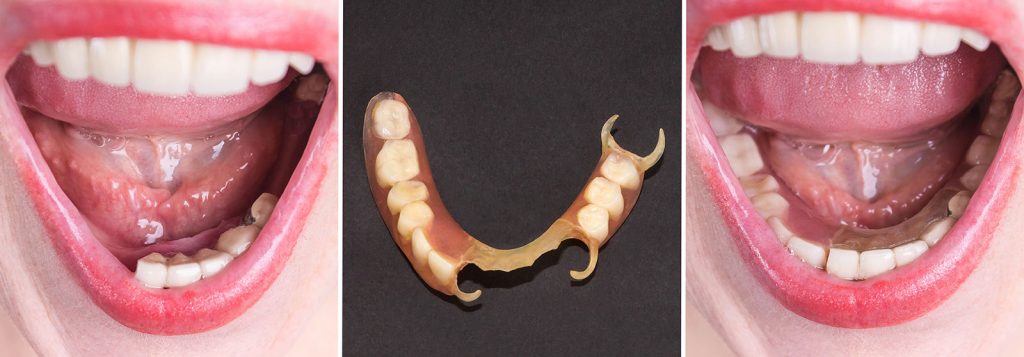 flexible dentures gold coast