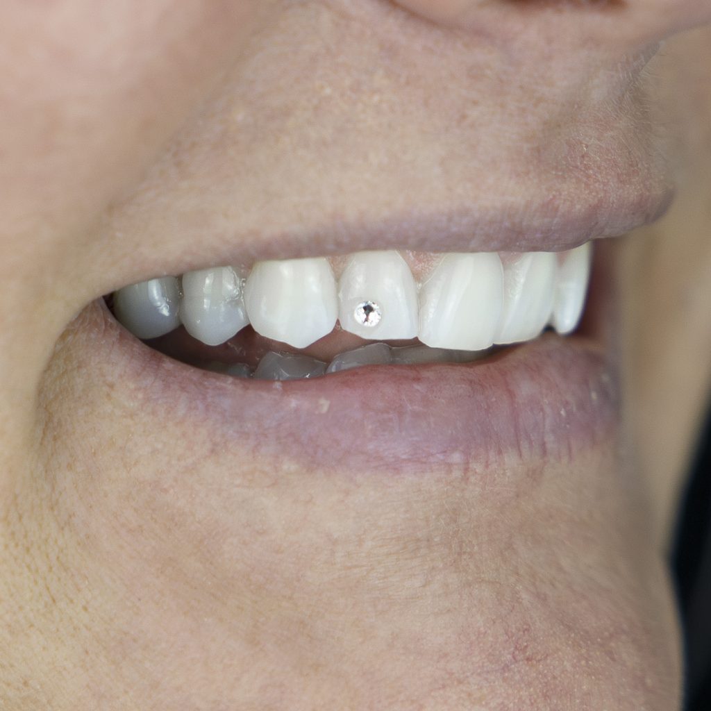 Tooth Gems - Gold Coast Dental Studio